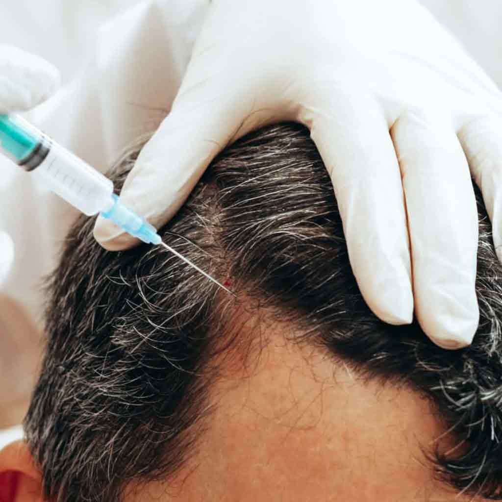 Exosomes_Hair_Restoration